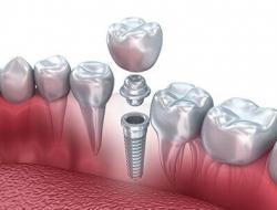 Имплантация зубов - беспроигрышный путь к здоровью!